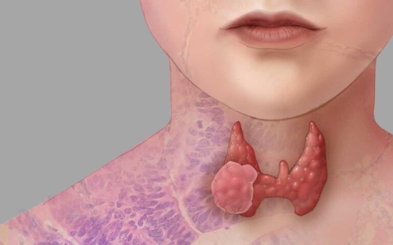 Thyroid