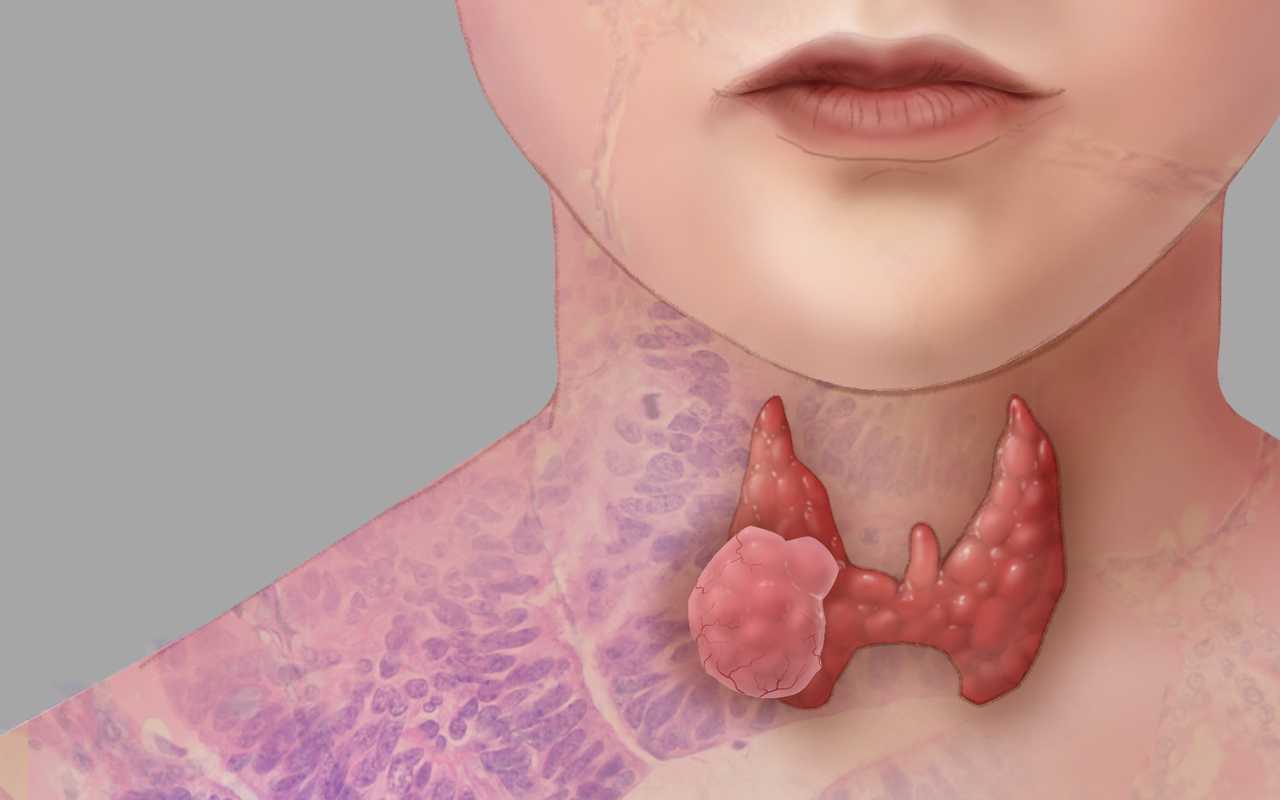 Thyroid